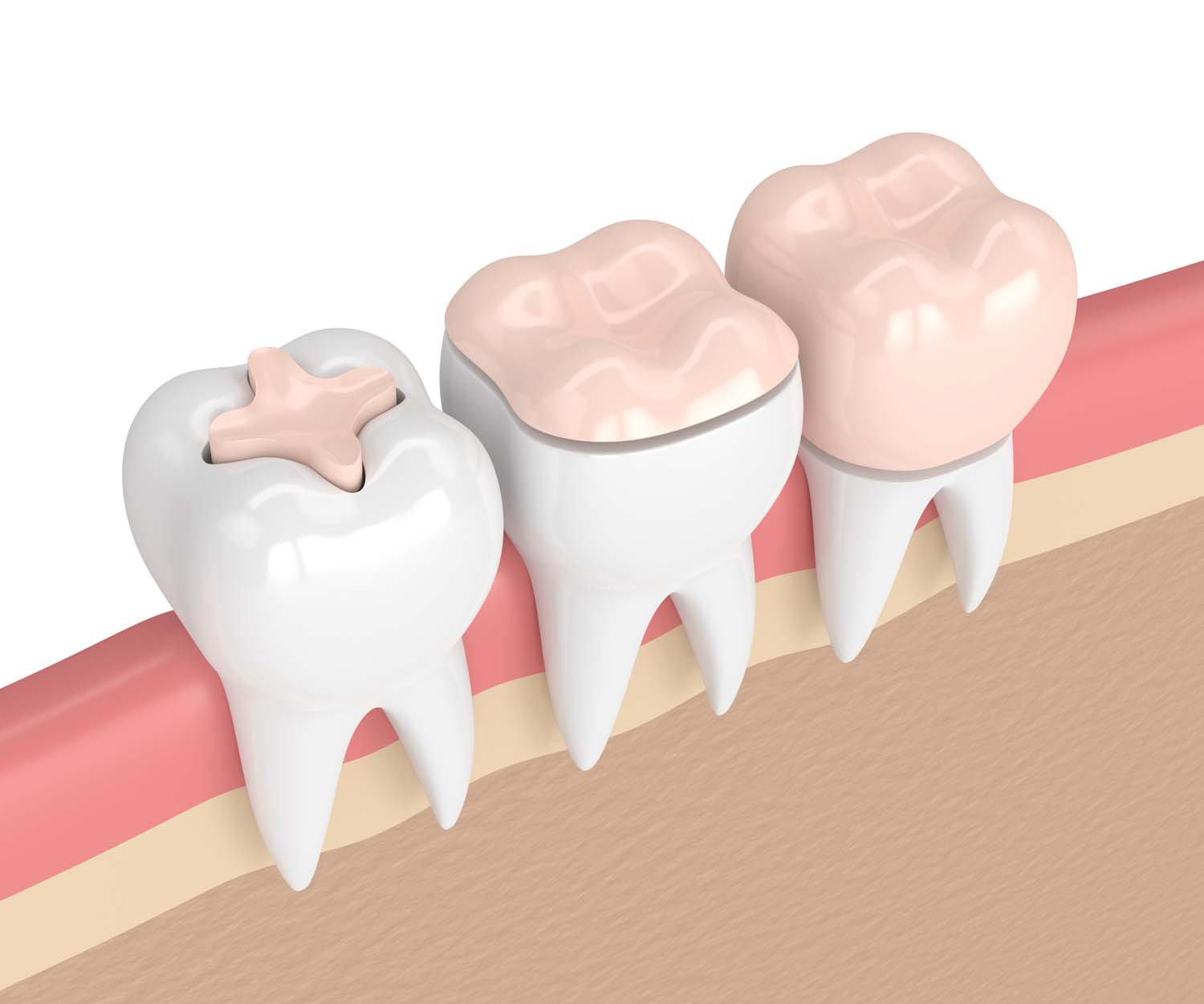 Dental Restorations in Two Hills Two Hills Dental Care